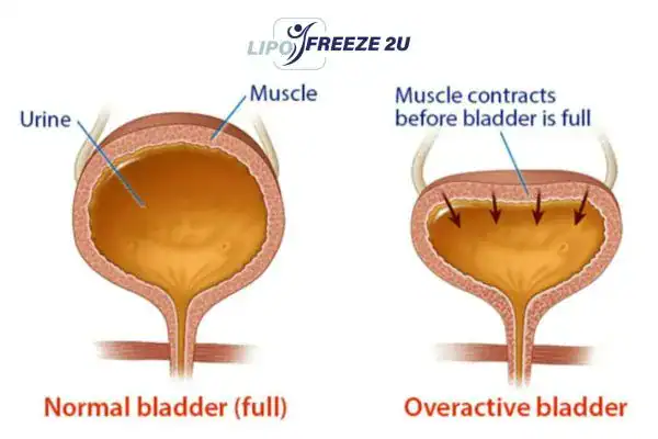 diagram of overactive bladder treatment Lyndhurst