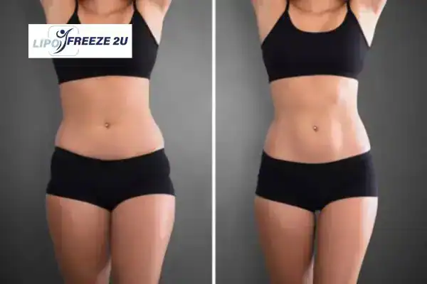 How Can LIPO FREEZE 2U Support Your Post-Pregnancy Body Recovery Lyndhurst?