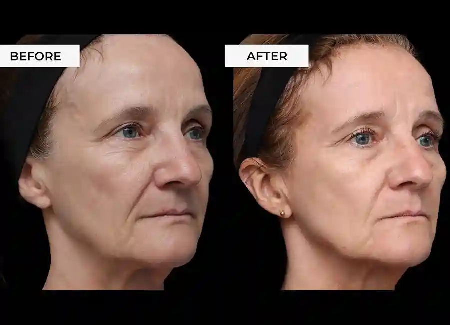 How Many RF Microneedling Sessions Will You Need to See a Difference Lyndhurst?